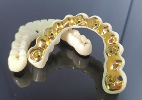 CAD/CAM Titanium Implant Bar + Zirconia Bridge