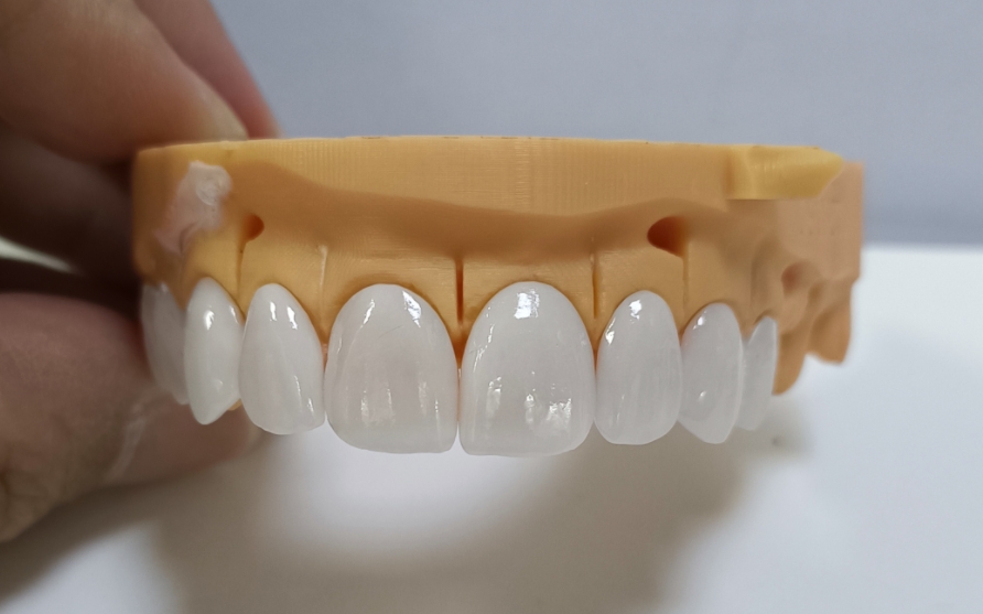 Veneers Emax Estetis Dhuwur