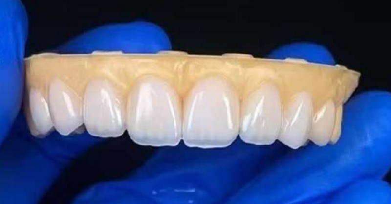 Veneers dental kanggo ndandani masalah kesenjangan untu sing gedhe banget