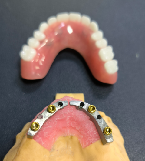 Locator lan Titanium Dental Bar