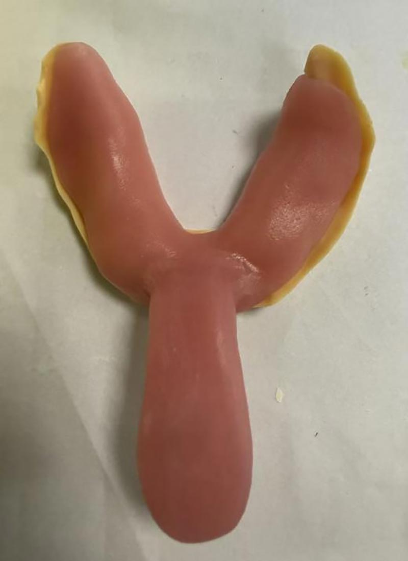 Sampeyan Ora Ngerti Babagan Tray Dental Custom