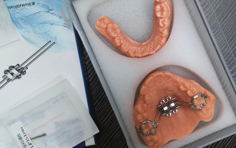 Ngerti MSE Skeletal Expansion karo WM Dental Lab