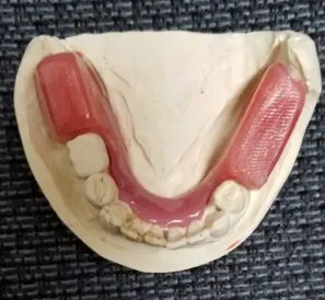 Pandhuan Klinis kanggo Denture Occlusal Rims: Fungsi, VDO, lan Aplikasi Langkah-demi-Langkah