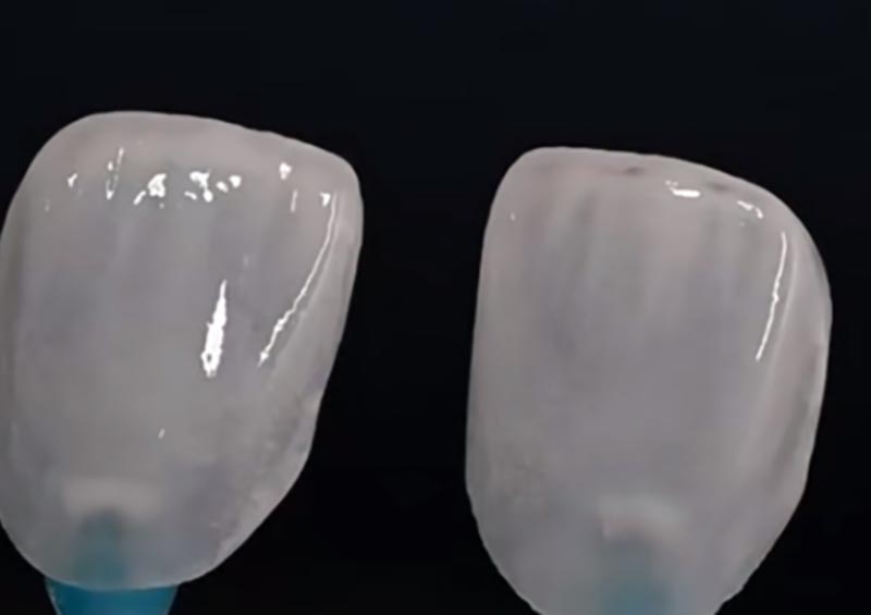 Veneers vs Crowns: Cara Milih Restorasi Tengen kanggo Hasil Estetis lan Fungsional Optimal