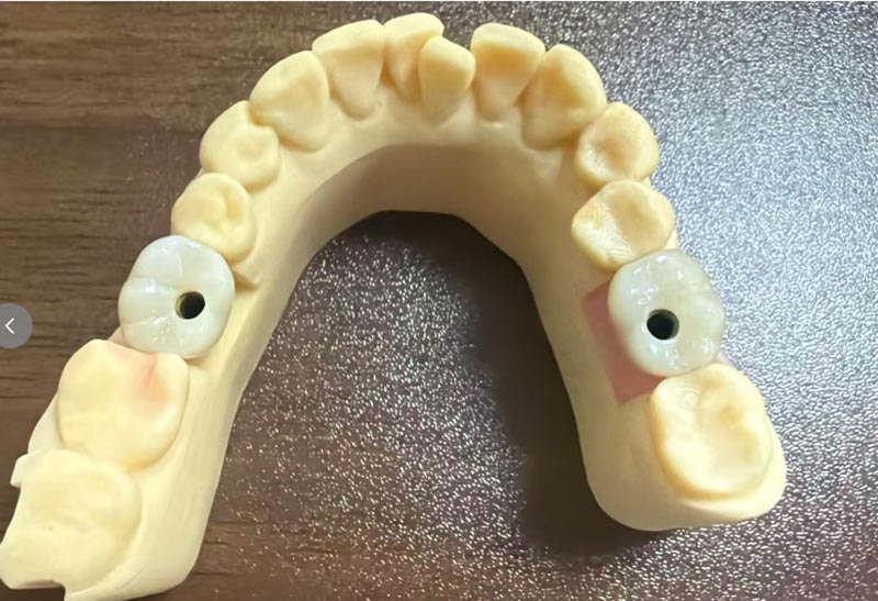 Napa Implantasi Gigi Ngarep Luwih Anggel Tinimbang Implantasi Gigi Posterior?