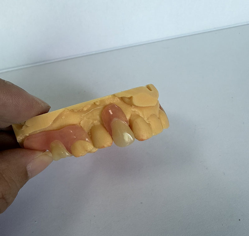 Valplast Partials ing WM Dental Lab