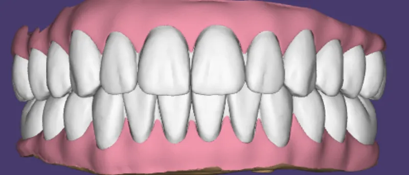 Desain kanggo Dentures dipindhah