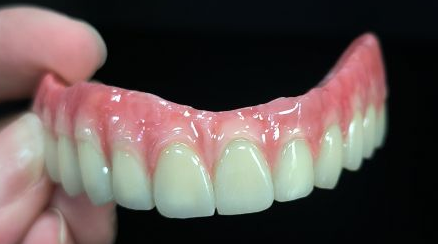 Kabeh ing 4 Sato - Malam Bridge Lengkap Mahkota Zirconia ing Struktur Titanium