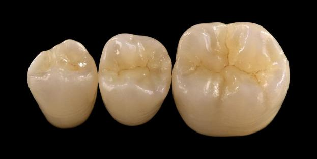 <h2>Zirkonia ing Dentistry: Indikasi, Kaluwihan, lan Pertimbangan Klinis</h2>
<p>Zirconia dikenal kanthi akeh amarga kekuatan lan daya tahan. Bahan zirconia generasi paling anyar uga nawakake sifat estetika sing luwih apik. Kanggo pasien sing nimbang restorasi kabeh-keramik, penting kanggo ngevaluasi kanthi ati-ati indikasi lan watesan sistem adhedhasar zirconia.</p>
<p>Pasien saiki luwih ngarepake pemugaran sing nggabungake estetika sing apik banget kanthi kinerja fungsional sing lengkap. Umume sistem keramik modern bisa nyukupi pangarepan kasebut, nanging sukses klinis umume gumantung saka pilihan materi sing tepat, persiapan waos, lan protokol sementasi. Pilihan kasebut kudu dipandu dening sifat material utama kayata resistensi fraktur, kekuatan lentur, resistensi nyandhang, lan stabilitas jangka panjang. Antarane bahan kasebut, zirconia wis dadi salah sawijining pilihan sing paling akeh digunakake ing kedokteran gigi restoratif kontemporer.</p>
<h3>Kenapa Pilih Zirconia?</h3>
<p>Zirconia dihargai amarga kekuatan sing luar biasa lan daya tahan jangka panjang. Zirconia modern beda banget karo generasi sadurunge, sing luwih buram lan kurang estetis. Saiki, teknologi CAD / CAM mbisakake fabrikasi pemugaran zirkonia kanthi sifat optik sing luwih apik.</p>
<p>Restorasi bisa dirancang minangka:</p>
<ul>
<li><strong>Zirconia monolitik:</strong>Cocog kanggo mahkota lan jembatan posterior, menehi kekuwatan lan daya tahan sing dhuwur.</li>
<li><strong>Zirconia lapisan:</strong>Cocog kanggo kasus sing mbutuhake estetika sing luwih apik, kalebu restorasi dawa ing macem-macem area tutuk.</li>
</ul>
<p>Kekuwatan lentur beda-beda gumantung saka jinis, wiwit saka kira-kira 590 MPa ing zirconia tembus dhuwur nganti 1400 MPa ing wangun monolitik. Restorasi zirkonia bisa disemen nggunakake semen resin adesif utawa semen ionomer kaca sing diowahi resin.</p>
<h3>Faktor Kunci ing Pamilihan Bahan Zirkonia</h3>
<p>Nalika nimbang zirconia kanggo restorasi kabeh-keramik, dokter kudu ngevaluasi sawetara faktor kritis:</p>
<ul>
<li>Sisa struktur gigi</li>
<li>Lokasi ing rongga lisan (zona estetika vs zona fungsional)</li>
<li>Anane kabiasaan parafunctional kayata bruxism</li>
<li>Translucency saka untu alam jejer</li>
<li>Warna lan kondisi struktur waos sing ndasari</li>
</ul>
<p>Zona estetika biasane kalebu untu anterior, sanajan ing sawetara pasien bisa nganti molar pisanan gumantung saka garis eseman lan dinamika rai. Zona fungsional umume kalebu premolar lan molar, ing ngendi gaya oklusal luwih dhuwur.</p>
<h3>Aplikasi Zona Fungsional</h3>
<p>Ing wilayah posterior, pasukan oklusal kudu dianggep kanthi teliti. Zirconia minangka alternatif sing apik kanggo pemugaran PFM tradisional, utamane ing kasus kanthi papan restoratif sing winates. Zirconia monolitik modern ngidini desain kontur lengkap anatomi oklusal, kalebu cusps fungsional lan ridges marginal, nalika njaga kekuatan dhuwur.</p>
<p>Bukti saiki nuduhake yen zirconia monolitik cocok kanggo mahkota posterior lan jembatan multi-unit amarga tahan banget kanggo patah lan nyandhang. Kemajuan ing teknik adesif lan desain persiapan uga nambah asil klinis jangka panjang.</p>
<h3>Aplikasi Zona Estetika</h3>
<p>Ing wilayah anterior, restorasi kudu rapet niru warna untu alami, translucency, lan prilaku cahya. Nalika bahan kayata lithium disilicate nawakake estetika sing apik, bahan kasebut kurang kuwat lan biasane mbutuhake ikatan adesif.</p>
<p>Kauntungan utama saka zirconia yaiku kemampuan kanggo disemen kanthi konvensional nalika isih entuk kinerja estetika sing dhuwur. Kanthi pangembangan sistem zirconia sing tembus dhuwur lan multilayer, saiki bisa ngasilake restorasi sing meh padha karo dentition alami.</p>
<p>Teknik pangolahan sing luwih maju nambahake sifat optik lan nyuda cacat sing bisa mengaruhi transmisi lan tampilan cahya.</p>
<h3>Kekuwatan lan Estetika Gabungan</h3>
<p>Sistem zirconia awal ngutamakake kekuwatan nanging ora nduweni kualitas estetis. Zirconia monolitik modern kasil nggabungake kekuatan lan penampilan sing luwih apik, saengga cocok kanggo macem-macem kasus klinis.</p>
<p>Utamane migunani kanggo pasien sing duwe kebiasaan parafungsi utawa gagal pemugaran sadurunge. Pasinaon klinis nuduhake panampa pasien sing dhuwur lan tingkat komplikasi sing sithik.</p>
<p>Keprigelan babagan nyandhang ing dentition lawan wis suda karo formulasi anyar. Permukaan zirconia sing dipoles banget nuduhake potensial abrasif sing sithik, lan ing sawetara kasus bisa uga luwih lembut tinimbang restorasi porselen-nyawiji-kanggo-logam tradisional.</p>
<h3>Implan Zirkonia: Alternatif Muncul</h3>
<p>Nalika implan titanium tetep dadi standar klinis, implan zirkonia entuk perhatian minangka alternatif bebas logam. Desain awal utamane sistem siji-potong, nanging implan zirkonia rong potong saiki ngidini keluwesan prostetik sing luwih apik.</p>
<p>Implan zirkonia utamané migunani ing kasus sing ana masalah estetis, kayata potensial werna abu-abu saka jaringan peri-implan utawa biotipe gingiva tipis. Padha uga bisa dianggep kanggo patients karo sensitivitas titanium langka.</p>
<p>Nanging, implan zirconia isih relatif anyar, lan data klinis jangka panjang tetep diwatesi dibandhingake karo sistem titanium.</p>
<h3>Kesimpulan</h3>
<p>Zirconia wis berkembang dadi bahan sing serbaguna ing kedokteran gigi restoratif, nyedhiyakake keseimbangan sing kuat antarane kinerja mekanik lan estetika. Pilihan kasus sing tepat lan ketaatan marang protokol klinis penting kanggo entuk asil sing optimal ing aplikasi anterior lan posterior.</p>