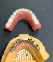 Locator lan bar dental